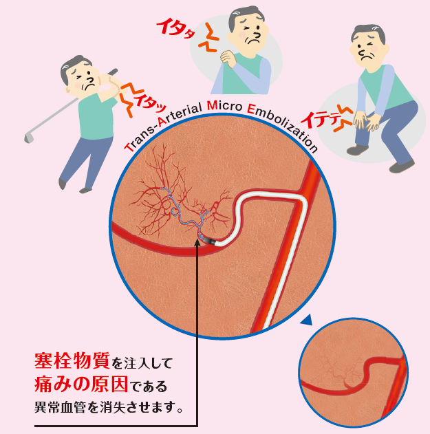 治療方法 費用 運動器疼痛 モヤモヤ血管 に対するカテーテル治療 奈良県立医科大学附属病院