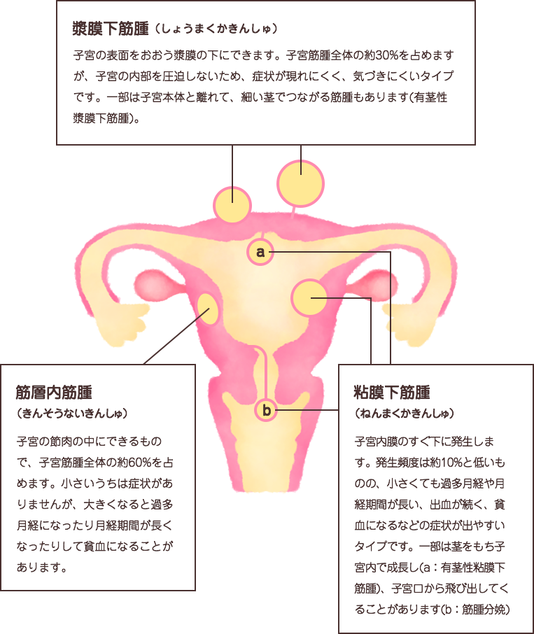 漿膜下筋腫（しょうまくかきんしゅ）とは、子宮の表面をおおう漿膜の下にできます。子宮筋腫全体の約30%を占めますが、子宮の内部を圧迫しないため、症状が現れにくく、気づきにくいタイプです。一部は子宮本体と離れて、細い茎でつながる筋腫もあります(有茎性漿膜下筋腫)。筋層内筋腫（きんそうないきんしゅ）とは、子宮の節肉の中にできるもので、子宮筋腫全体の約60%を占めます。小さいうちは症状がありませんが、大きくなると過多月経になったり月経期間が長くなったりして貧血になることがあります。粘膜下筋腫（ねんまくかきんしゅ）とは、子宮内膜のすぐ下に発生します。発生頻度は約10%と低いものの、小さくても過多月経た月経期間が長い、出血が続く、貧血になるなどの症状が出やすいタイプです。一部は茎をもち子宮内で成長し(a：有茎性粘膜下筋腫)、子宮口から飛び出してくることがあります(b：筋腫分娩)