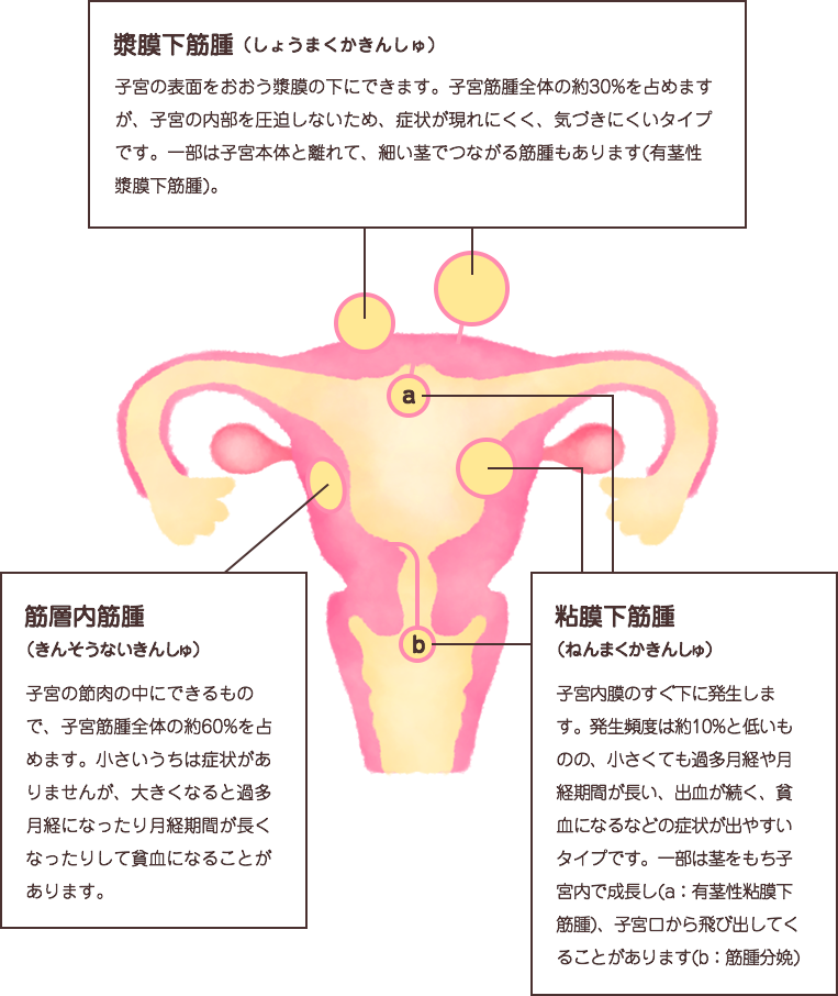 筋腫 子宮 子宮筋腫・子宮内膜症│ 琴似産科婦人科クリニック