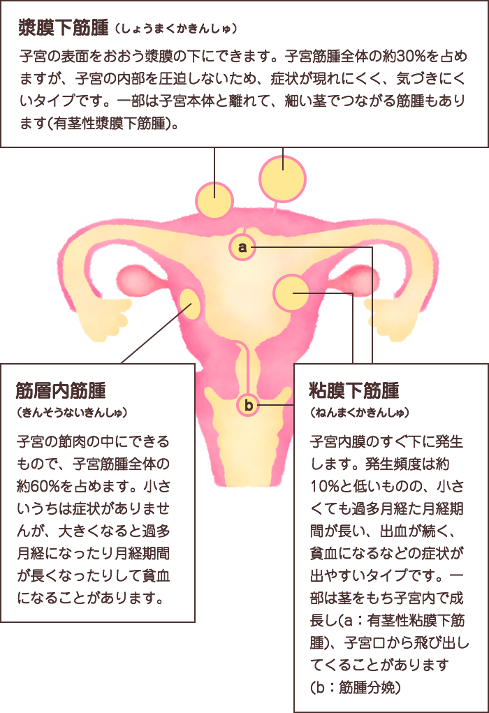 漿膜下筋腫（しょうまくかきんしゅ）とは、子宮の表面をおおう漿膜の下にできます。子宮筋腫全体の約30%を占めますが、子宮の内部を圧迫しないため、症状が現れにくく、気づきにくいタイプです。一部は子宮本体と離れて、細い茎でつながる筋腫もあります(有茎性漿膜下筋腫)。筋層内筋腫（きんそうないきんしゅ）とは、子宮の節肉の中にできるもので、子宮筋腫全体の約60%を占めます。小さいうちは症状がありませんが、大きくなると過多月経になったり月経期間が長くなったりして貧血になることがあります。粘膜下筋腫（ねんまくかきんしゅ）とは、子宮内膜のすぐ下に発生します。発生頻度は約10%と低いものの、小さくても過多月経や月経期間が長い、出血が続く、貧血になるなどの症状が出やすいタイプです。一部は茎をもち子宮内で成長し(a：有茎性粘膜下筋腫)、子宮口から飛び出してくることがあります(b：筋腫分娩)
